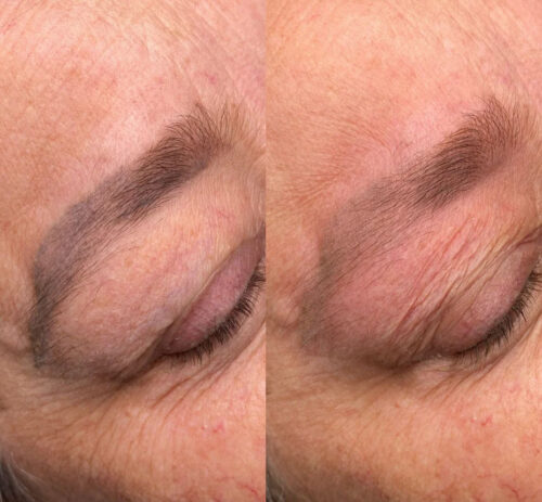 Air Essence Nd YAG PRO X Pikosekundový laser na odstranění tetování s funkcí chlazení photo review